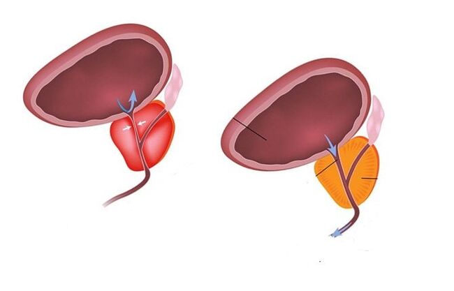 vesela un slima prostata