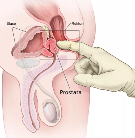 Prostatas masāža